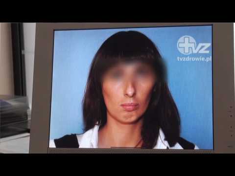 Czy można odwrócić efekt operacji plastycznej?